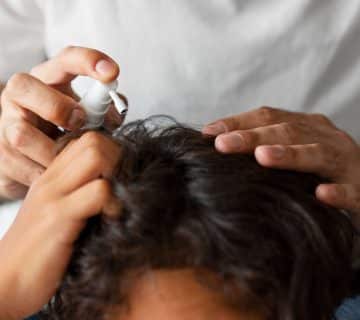 Should You Use Virgin Coconut Oil for Dandruff