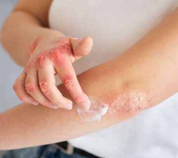 Virgin Coconut Oil for Yeast Infection: How It Works and Application Tips