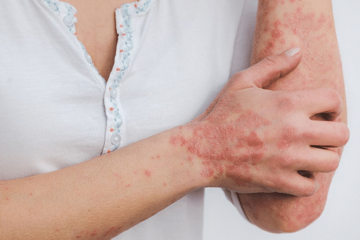 what is psoriasis